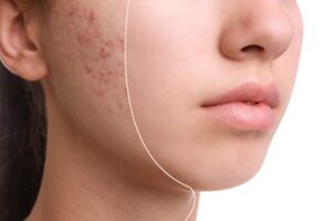 Accutane 20 for Sale