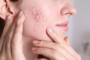 Why some people often buy Ultima-Accutane online today